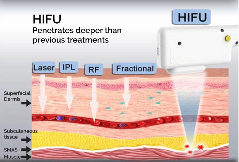 High Intensity Focused Ultrasound Facial