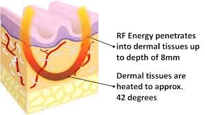 RF Skin Tightening RF Skin Tightening