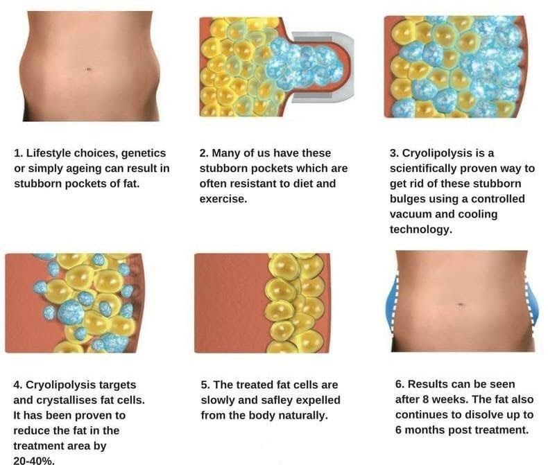 Cryolipolysis Treatment Epic Gems & Extensions Plus Body Contouring Cobourg